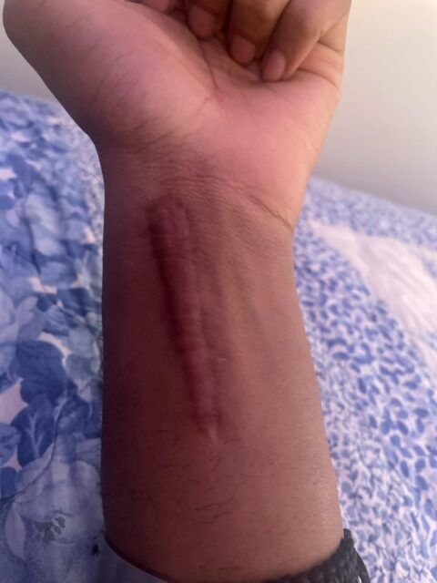 need idea for a tattoo over a scar i got from a skating accident